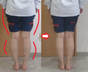 センター北のO脚矯正、ビフォーアフター